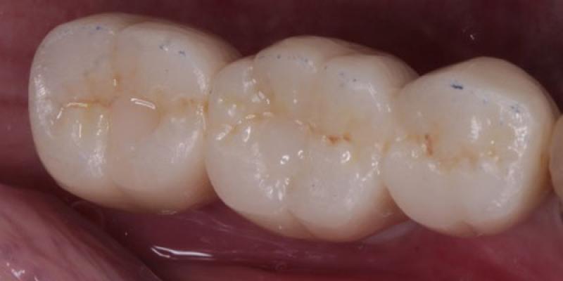 Smile-Making <b>Dental Transplants</b> in Hale & Hale Barns