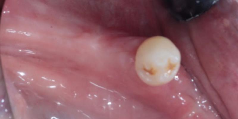 Smile-Making <b>Dental Transplants</b> in Hale & Hale Barns